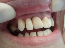 Restorative dentistry